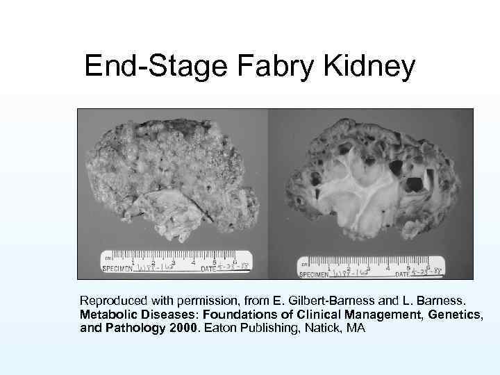 End-Stage Fabry Kidney Reproduced with permission, from E. Gilbert-Barness and L. Barness. Metabolic Diseases: