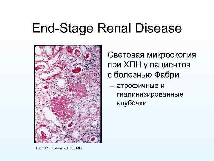 End-Stage Renal Disease • Световая микроскопия при ХПН у пациентов с болезнью Фабри –