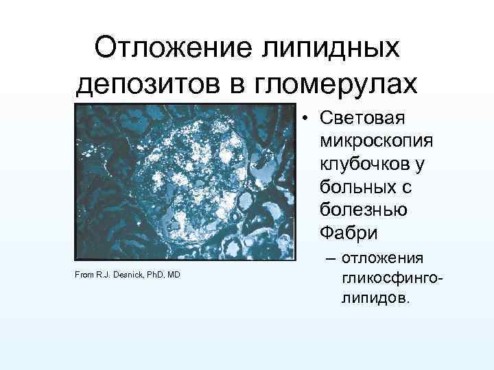 Отложение липидных депозитов в гломерулах • Световая микроскопия клубочков у больных с болезнью Фабри