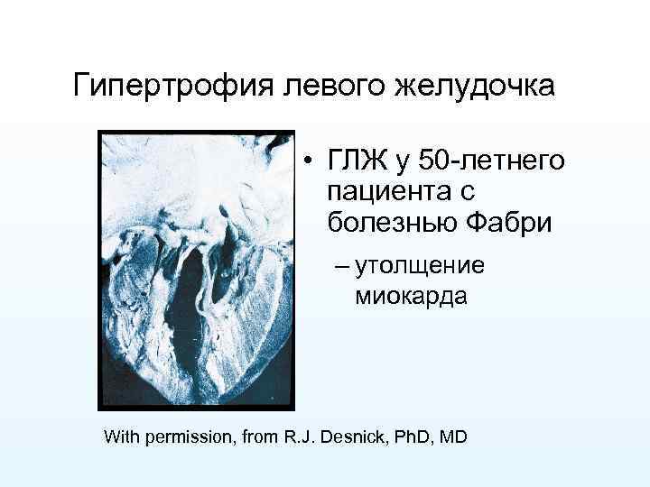 Гипертрофия левого желудочка • ГЛЖ у 50 -летнего пациента с болезнью Фабри – утолщение