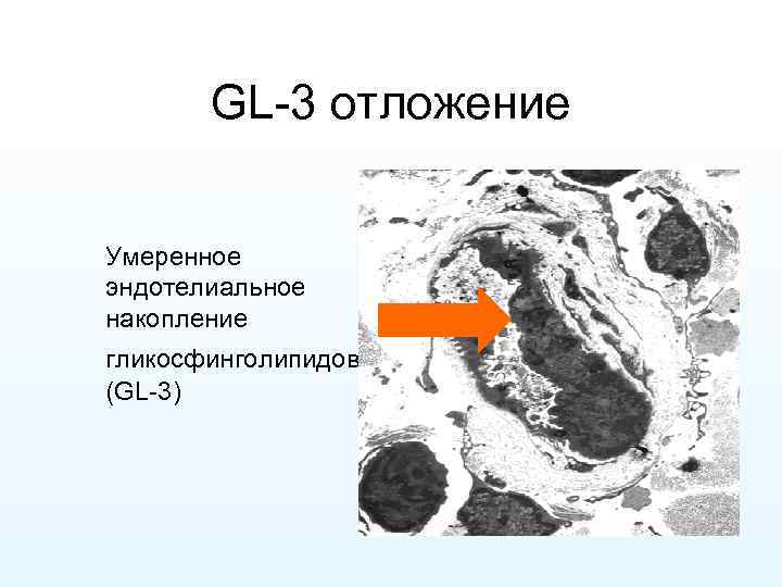GL-3 отложение Умеренное эндотелиальное накопление гликосфинголипидов (GL-3) 