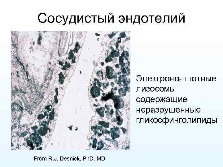 Сосудистый эндотелий Электроно-плотные лизосомы содержащие неразрушенные гликосфинголипиды From R. J. Desnick, Ph. D, MD