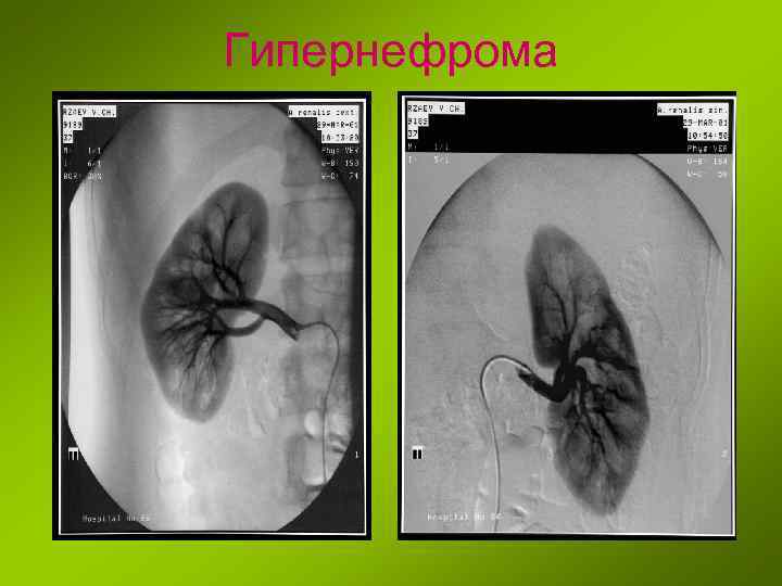 Гипернефрома 