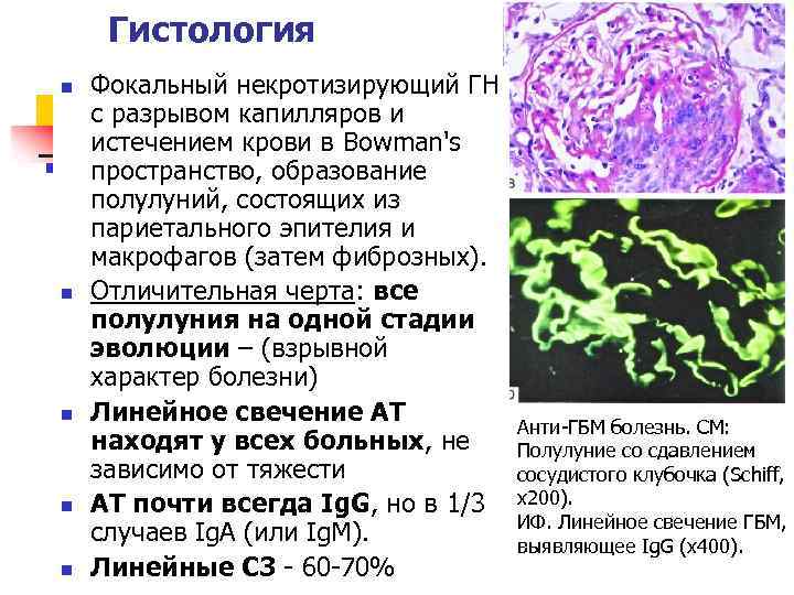 Гистология n n n Фокальный некротизирующий ГН с разрывом капилляров и истечением крови в