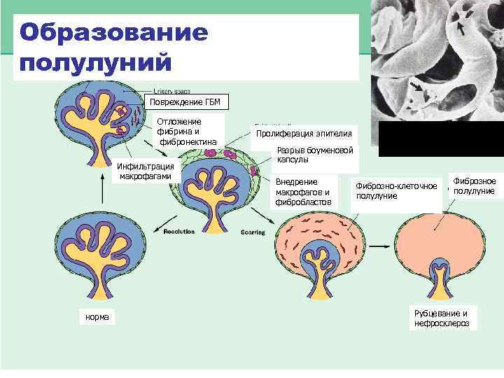 Схема иммунокомплексного повреждения клубочков