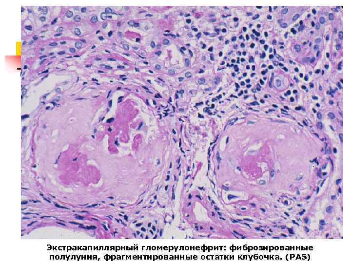 Экстракапиллярный гломерулонефрит: фиброзированные полулуния, фрагментированные остатки клубочка. (PAS) 