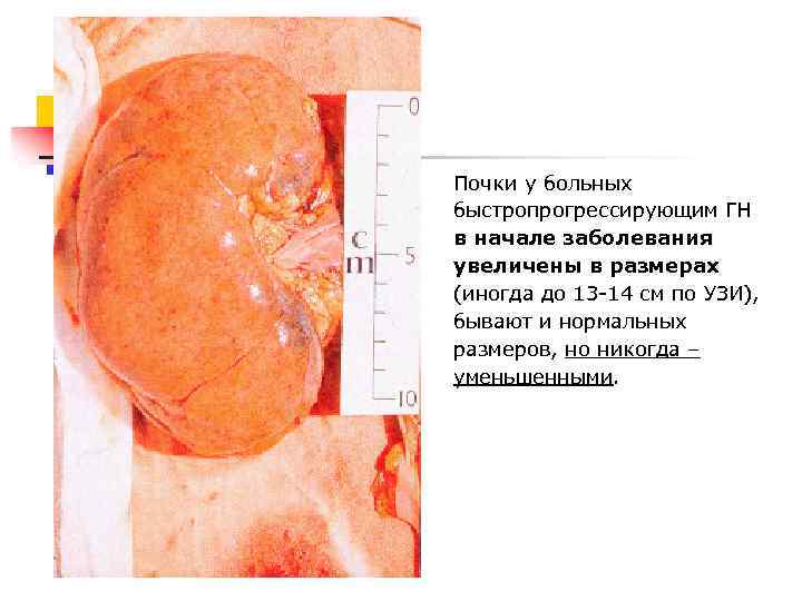 Почки у больных быстропрогрессирующим ГН в начале заболевания увеличены в размерах (иногда до 13
