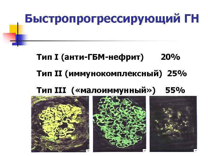 Быстропрогрессирующий ГН Тип I (анти-ГБМ-нефрит) 20% Тип II (иммунокомплексный) 25% Тип III ( «малоиммунный»
