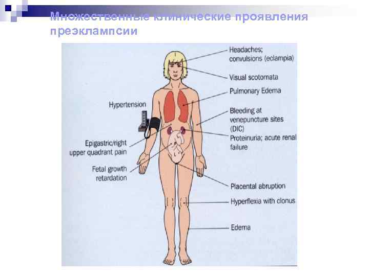 Множественные клинические проявления преэклампсии 