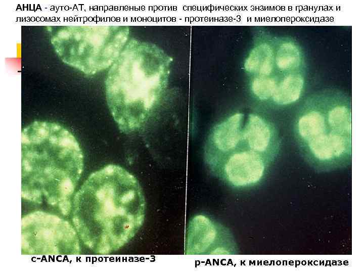 АНЦА - ауто-АТ, направленые против специфических энзимов в гранулах и лизосомах нейтрофилов и моноцитов