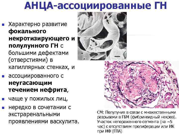 АНЦА-ассоциированные ГН n n Характерно развитие фокального некротизирующего и полулунного ГН с большими дефектами