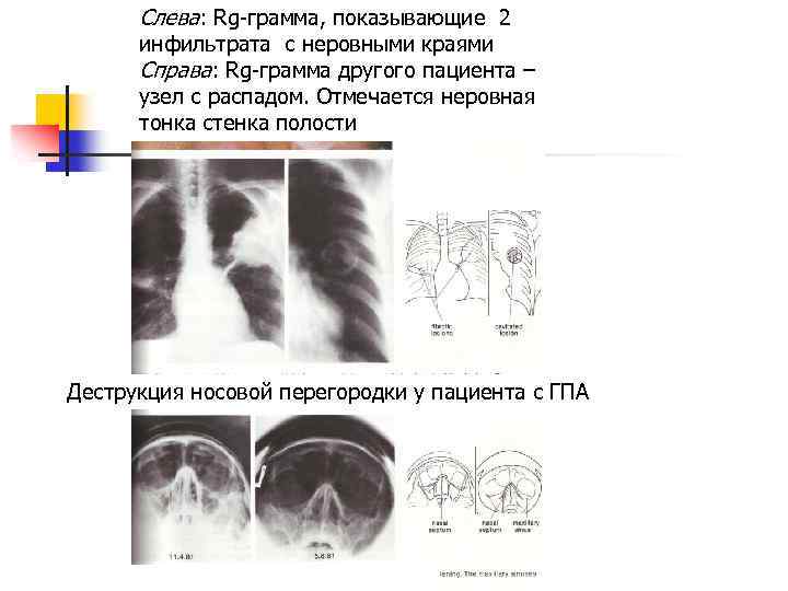 Слева: Rg-грамма, показывающие 2 инфильтрата с неровными краями Справа: Rg-грамма другого пациента – узел