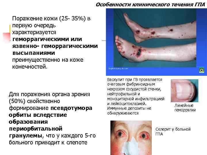 Особенности клинического течения ГПА Поражение кожи (25 - 35%) в первую очередь характеризуется геморрагическими