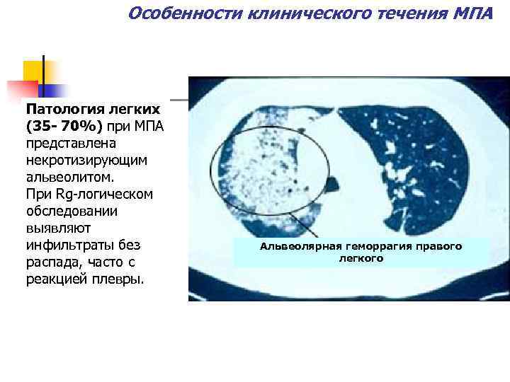 Особенности клинического течения МПА Патология легких (35 - 70%) при МПА представлена некротизирующим альвеолитом.