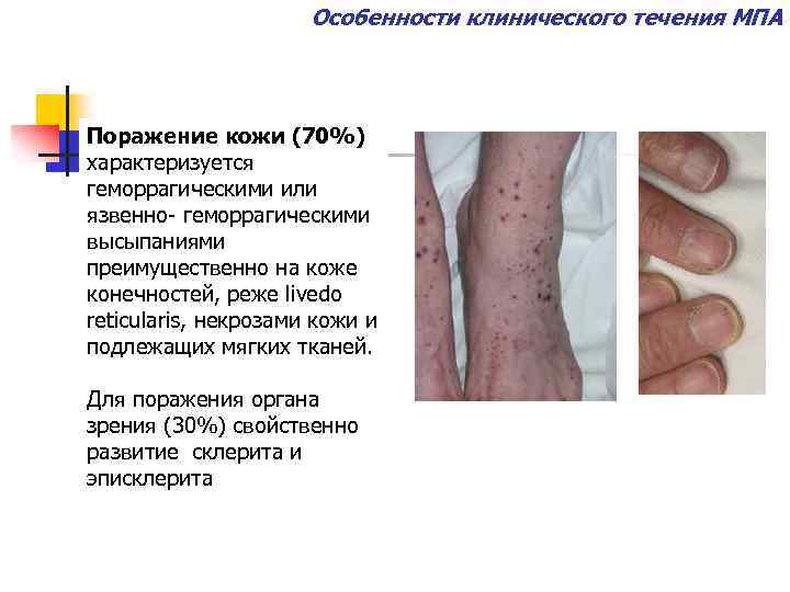 Особенности клинического течения МПА Поражение кожи (70%) характеризуется геморрагическими или язвенно- геморрагическими высыпаниями преимущественно