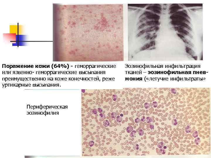 Поражение кожи (64%) - геморрагические или язвенно- геморрагические высыпания преимущественно на коже конечностей, реже