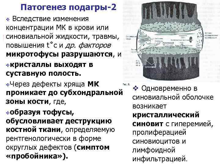 Подагра патогенез. Патогенез подагры. Патогенез острого подагрического артрита. Механизм развития подагры. Патогенез подагры схема.