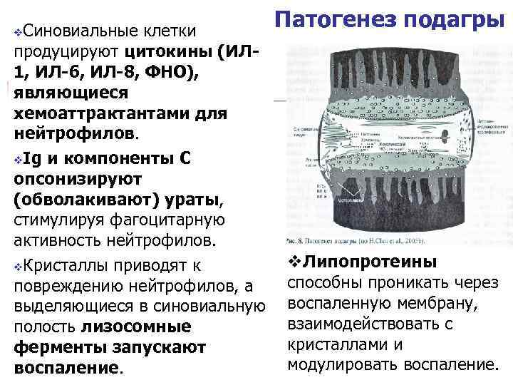 Подагра патогенез схема