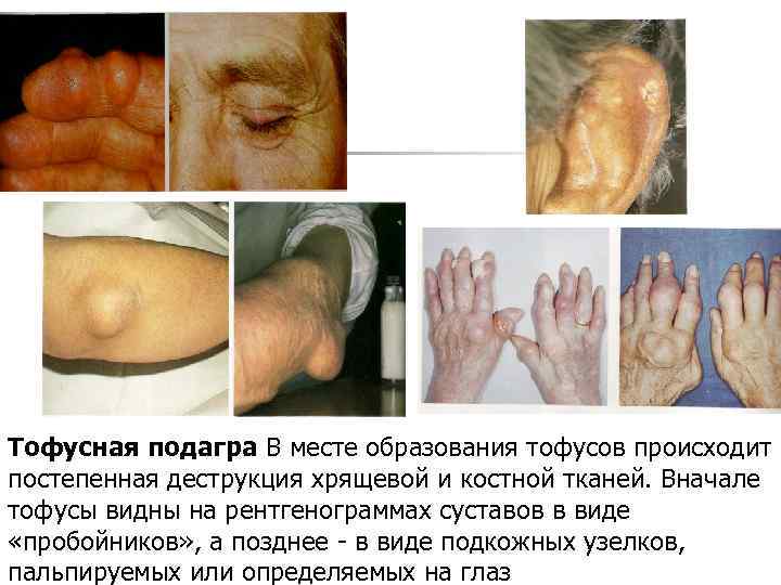 Тофусная подагра В месте образования тофусов происходит постепенная деструкция хрящевой и костной тканей. Вначале