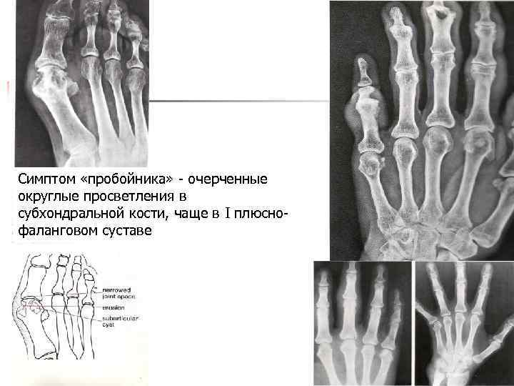 Симптом «пробойника» - очерченные округлые просветления в субхондральной кости, чаще в I плюснофаланговом суставе
