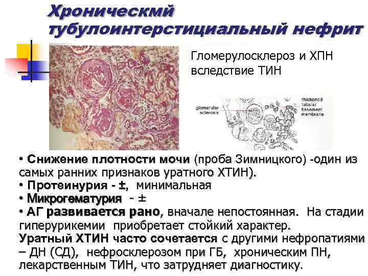 Хроническмй тубулоинтерстициальный нефрит Гломерулосклероз и ХПН вследствие ТИН • Снижение плотности мочи (проба Зимницкого)