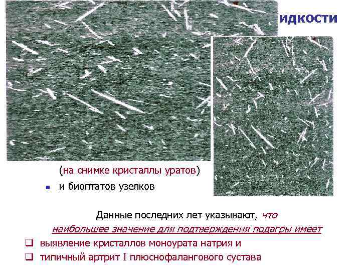 Исследование синовиальной жидкости Большое значение в дифференциальной диагностике микрокристаллических артропатий имеет n n поляризационная