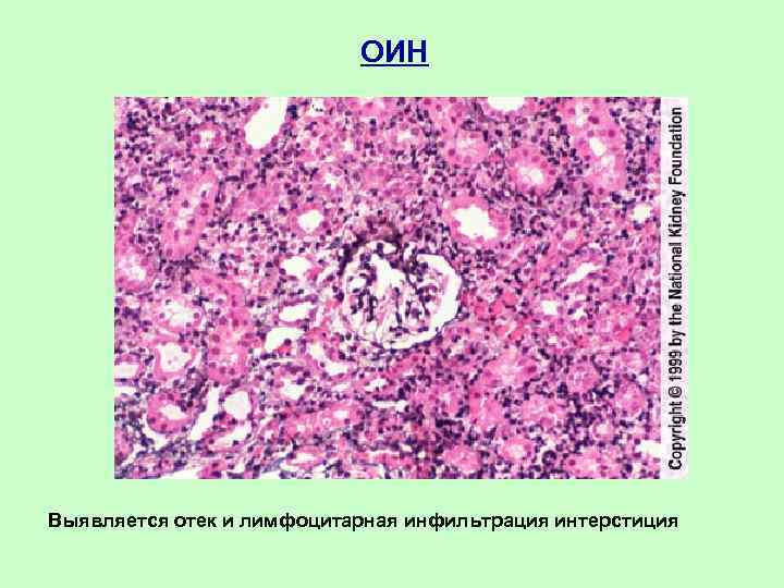 ОИН Выявляется отек и лимфоцитарная инфильтрация интерстиция 