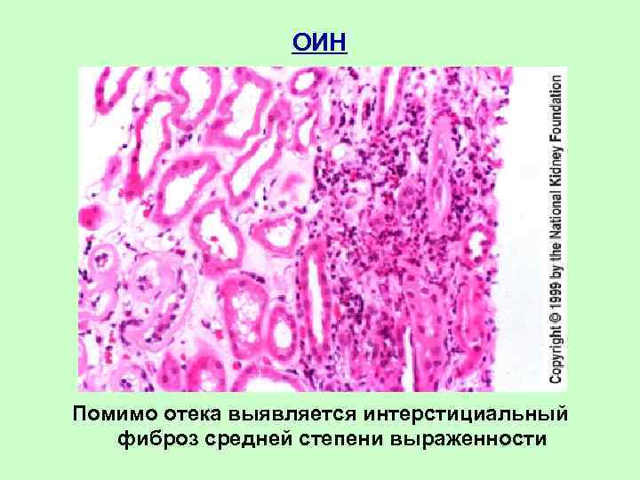 ОИН Помимо отека выявляется интерстициальный фиброз средней степени выраженности 