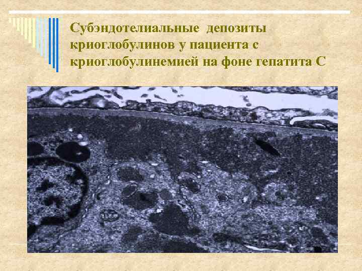 Субэндотелиальные депозиты криоглобулинов у пациента с криоглобулинемией на фоне гепатита С 