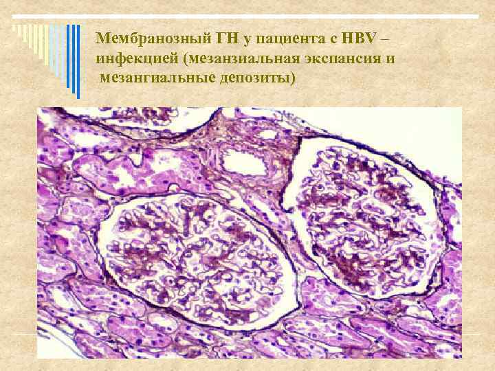 Мембранозный ГН у пациента с HBV – инфекцией (мезанзиальная экспансия и мезангиальные депозиты) 