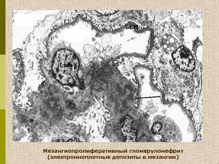 Мезангиопролиферативный гломерулонефрит (электронноплотные депозиты в мезангии) 