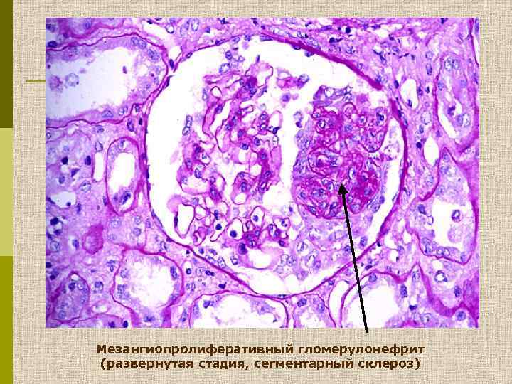 Мезангиопролиферативный гломерулонефрит (развернутая стадия, сегментарный склероз) 