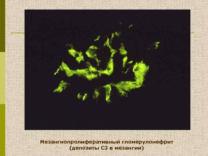 Мезангиопролиферативный гломерулонефрит (депозиты C 3 в мезангии) 