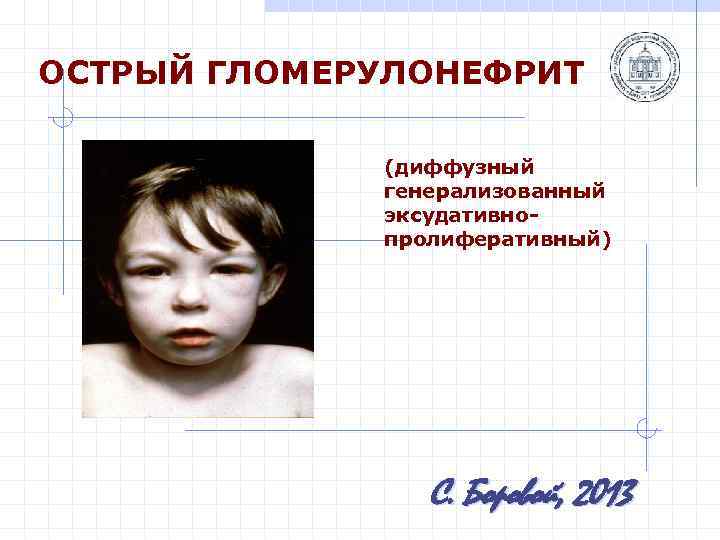 ОСТРЫЙ ГЛОМЕРУЛОНЕФРИТ (диффузный генерализованный эксудативнопролиферативный) С. Боровой, 2013 