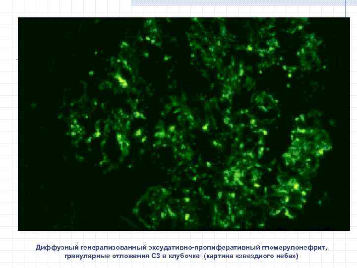 Диффузный генерализованный эксудативно-пролиферативный гломерулонефрит, гранулярные отложения С 3 в клубочке (картина «звездного неба» )