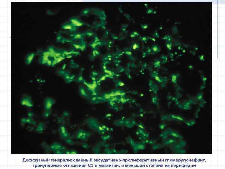 Диффузный генерализованный эксудативно-пролиферативный гломерулонефрит, гранулярные отложения С 3 в мезангии, в меньшей степени на