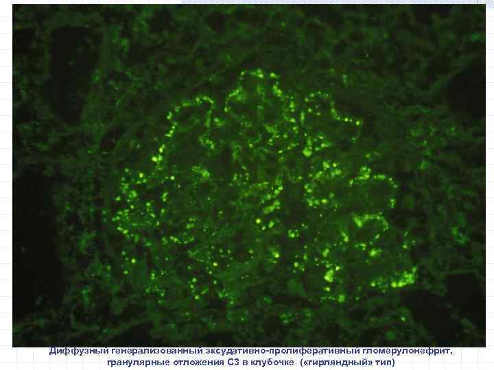 Диффузный генерализованный эксудативно-пролиферативный гломерулонефрит, гранулярные отложения С 3 в клубочке ( «гирляндный» тип) 