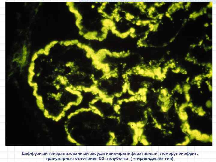 Диффузный генерализованный эксудативно-пролиферативный гломерулонефрит, гранулярные отложения С 3 в клубочке ( «гирляндный» тип) 