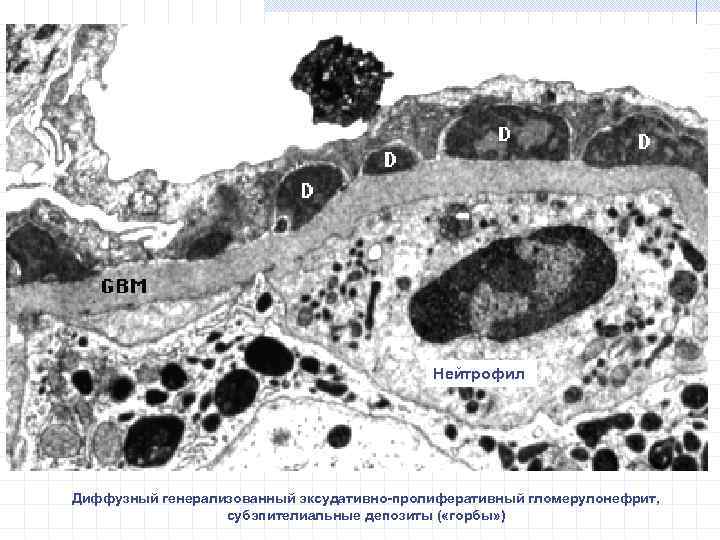 Нейтрофил Диффузный генерализованный эксудативно-пролиферативный гломерулонефрит, субэпителиальные депозиты ( «горбы» ) 