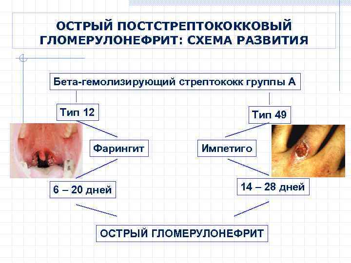 Гломерулонефрит карта вызова