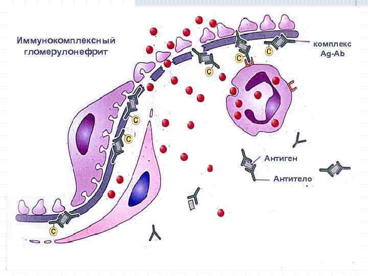 Схема иммунокомплексного повреждения клубочков
