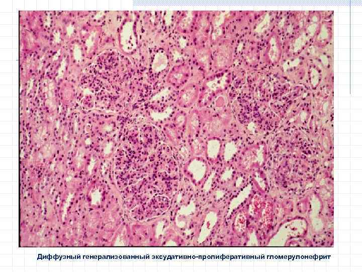 Острый гломерулонефрит картинки