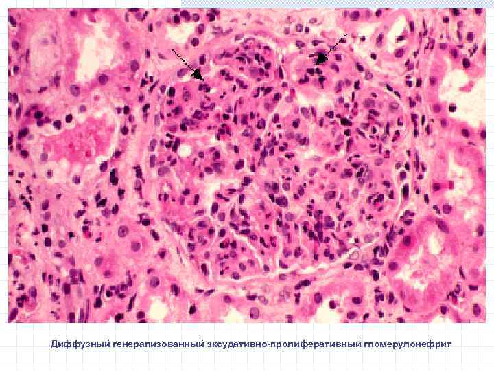 Диффузный генерализованный эксудативно-пролиферативный гломерулонефрит 