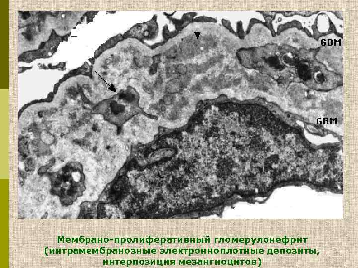 Мембрано-пролиферативный гломерулонефрит (интрамембранозные электронноплотные депозиты, интерпозиция мезангиоцитов) 