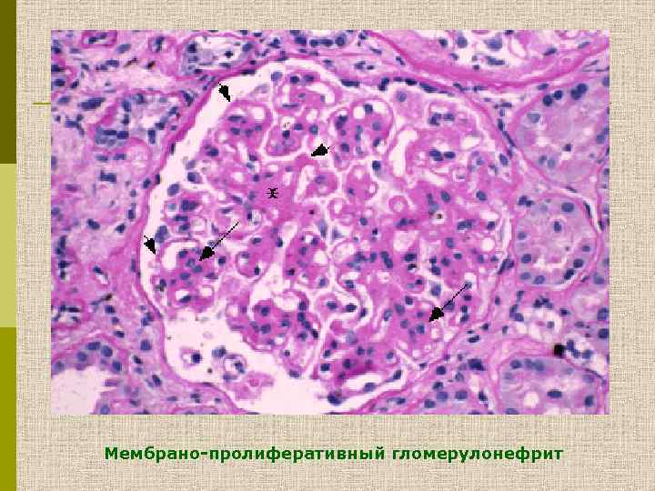 Мембрано-пролиферативный гломерулонефрит 