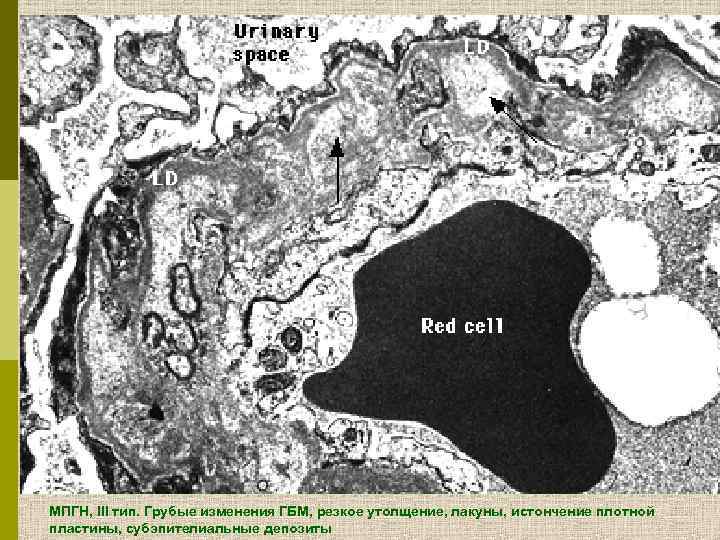 МПГН, III тип. Грубые изменения ГБМ, резкое утолщение, лакуны, истончение плотной пластины, субэпителиальные депозиты