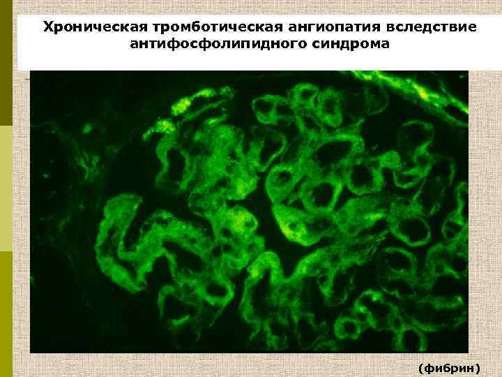 Хроническая тромботическая ангиопатия вследствие антифосфолипидного синдрома (фибрин) 