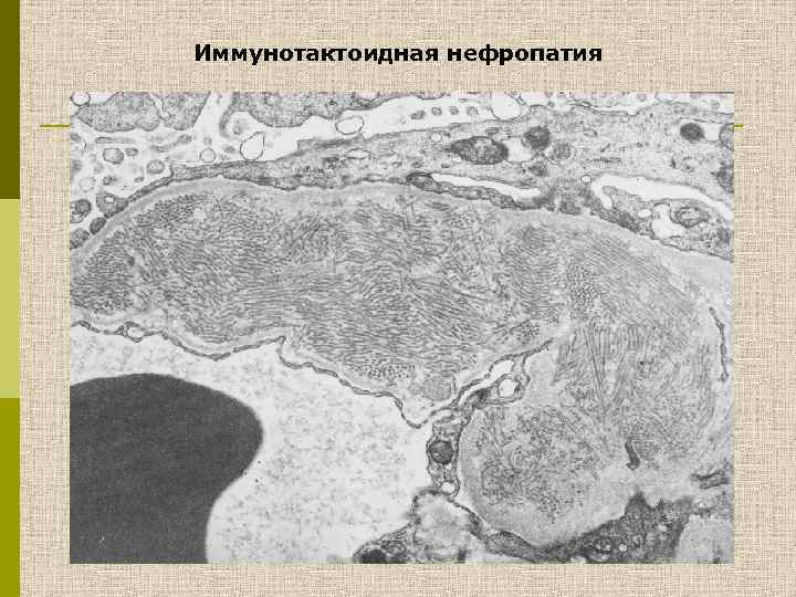 Иммунотактоидная нефропатия 