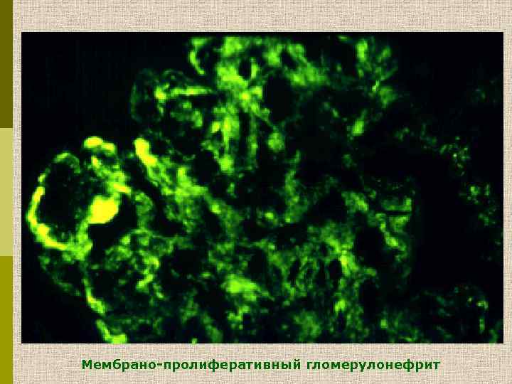 Мембрано-пролиферативный гломерулонефрит 