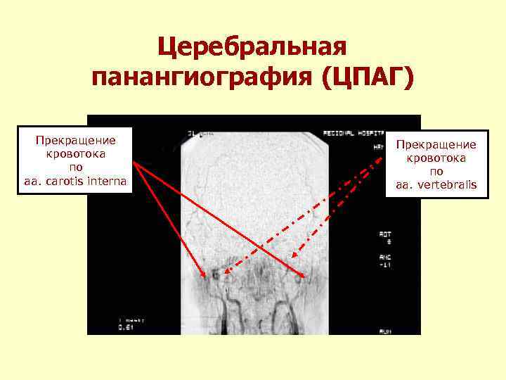 Церебральная панангиография (ЦПАГ) Прекращение кровотока по аa. carotis interna Прекращение кровотока по aa. vertebralis